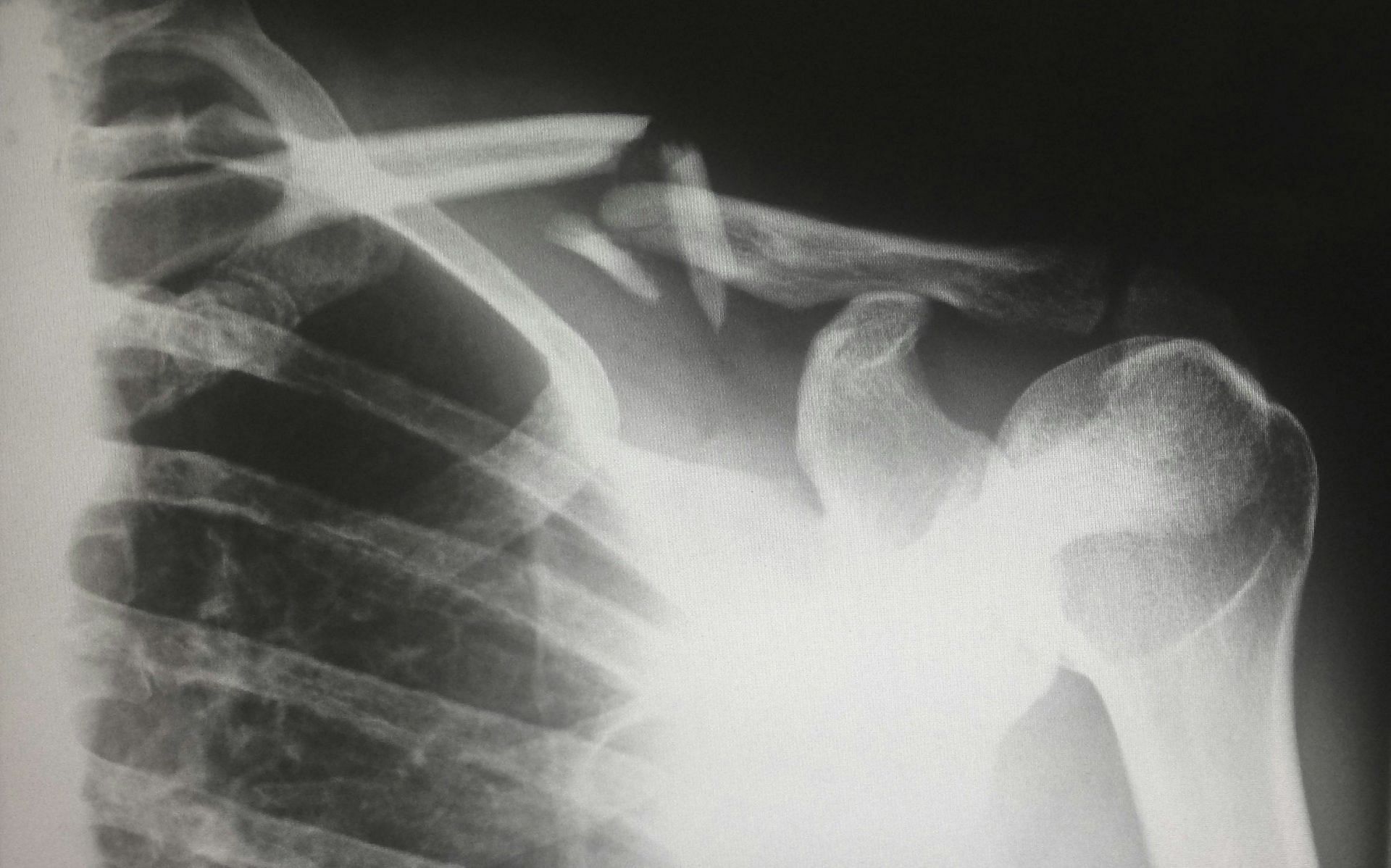 Xray of the chest to determine underlying wheezing causes (Image by Harlie Raethel/Unsplash)